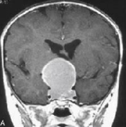 颅咽管瘤复发了有什么治疗方法？