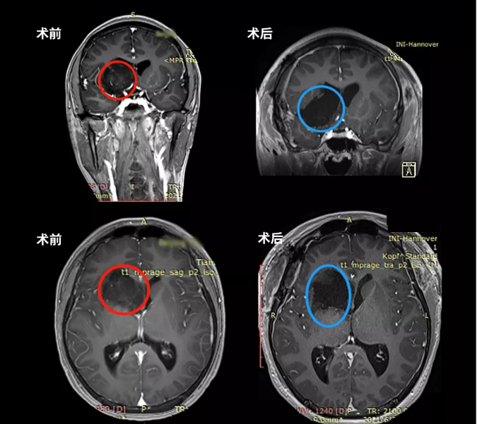 功能区胶质瘤案例