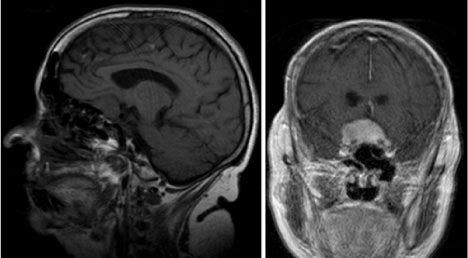 脑膜瘤什么情况下需要手术？