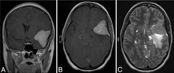 脑膜瘤什么情况下需要手术？