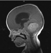 髓母细胞瘤治疗方案怎么选？治愈率是多少？