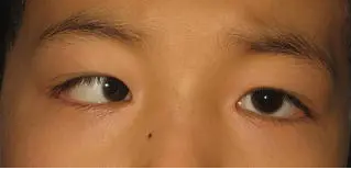 儿童后颅窝肿瘤的临床表现有哪些？