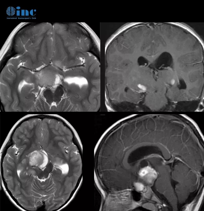 双侧视神经和下丘脑胶质瘤案例