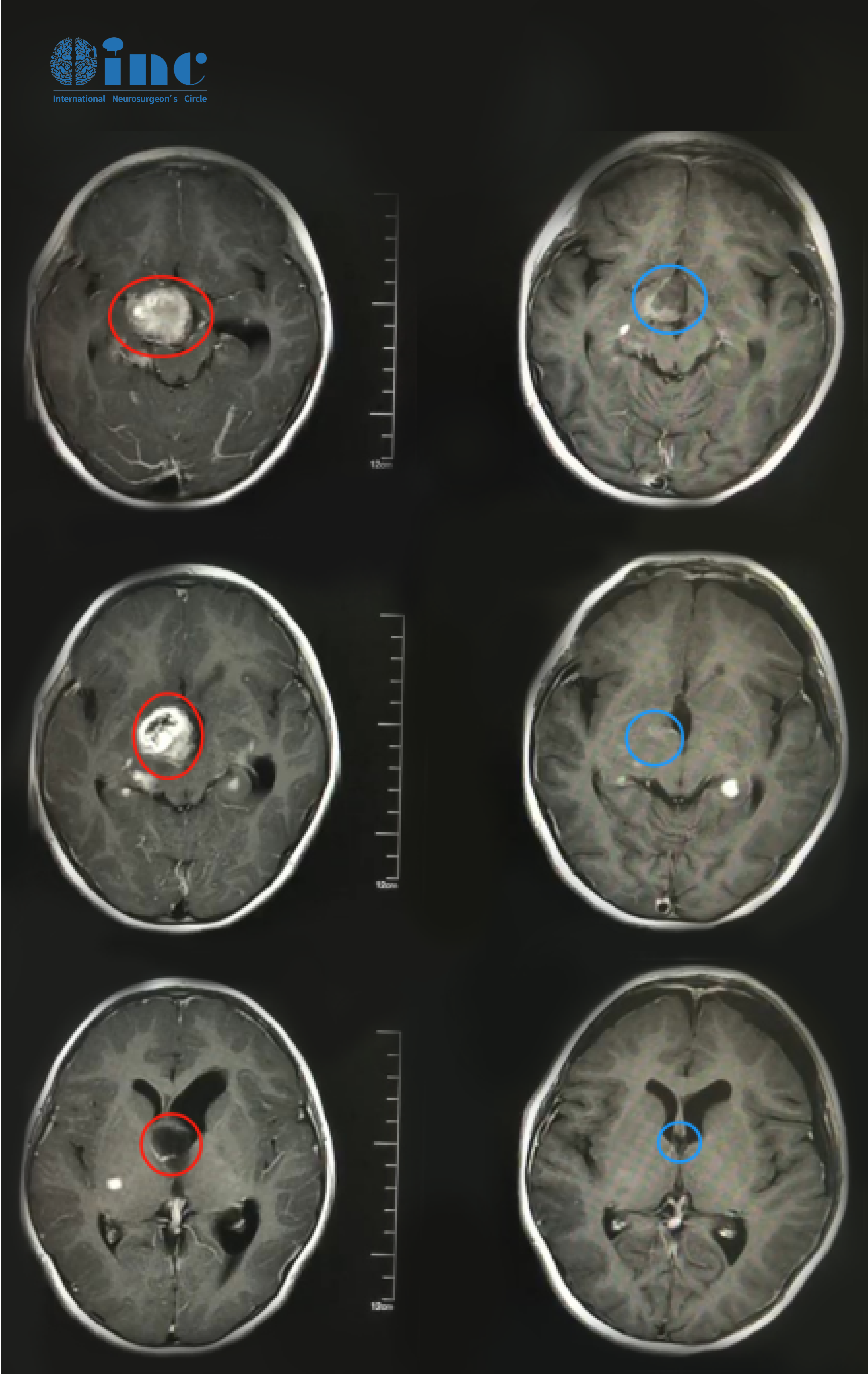 双侧视神经和下丘脑胶质瘤案例