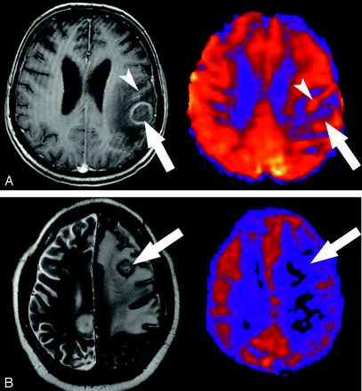 儿童低级别胶质瘤研究，BRAF V600E控制治疗数据