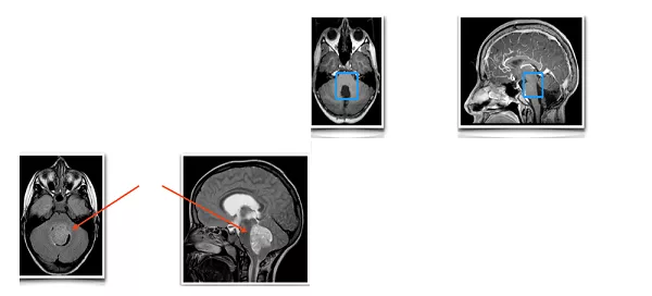 儿童髓母细胞瘤