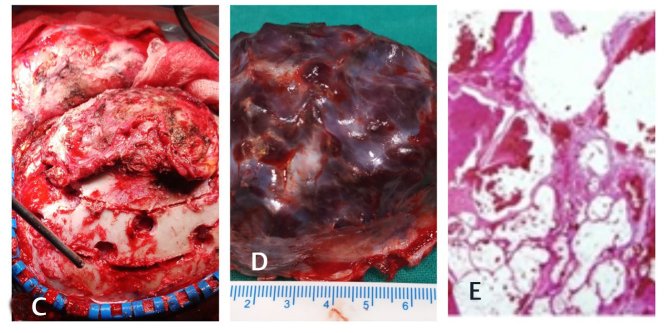 治疗较大钙化海绵状脑血管瘤