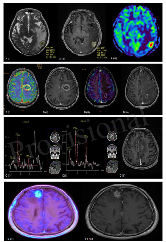 脑转移瘤放射性脑坏死一旦发生"很致命"，放射性脑坏死该如何处理？