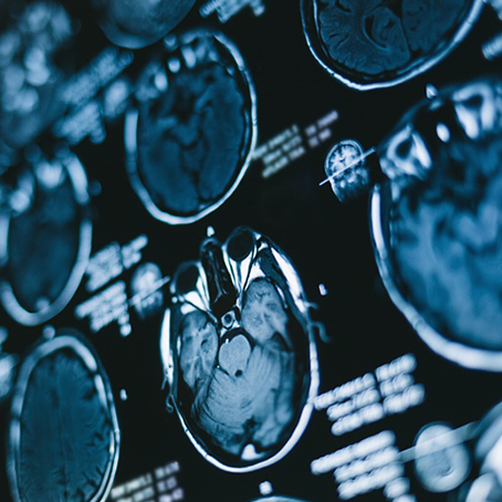 脑瘤手术怎样才算成功，如何争取较大的手术成功率？一文了解清楚