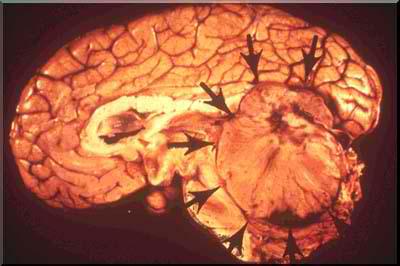 髓母细胞瘤病因：是什么引起了这个儿童恶性脑瘤？