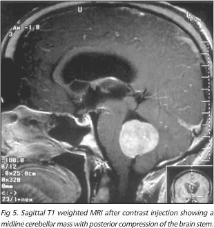 儿童健康杀手之一的髓母细胞瘤发病率是多少？