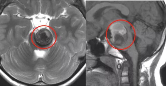 脑干海绵状血管瘤案例：看“拆弹专家”巴特朗菲教授如何为7岁男童全切脑干肿瘤