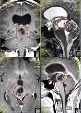 （小齐术前MRI）