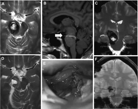 脑干海绵状血管瘤怎么治疗 图片1