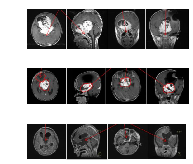 视路胶质瘤是什么病？听说会遗传