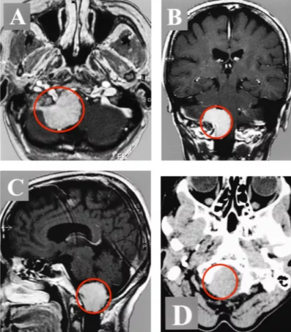 枕骨大孔脑膜瘤图片