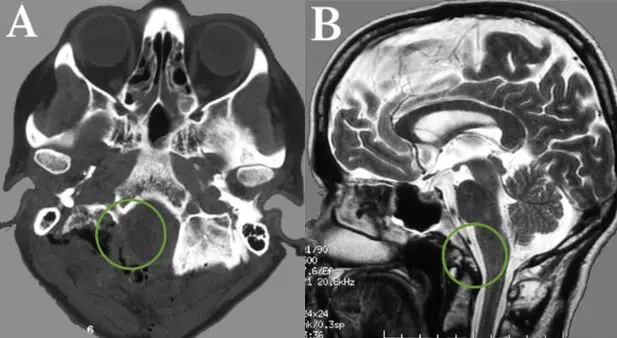 枕骨大孔脑膜瘤CT图片