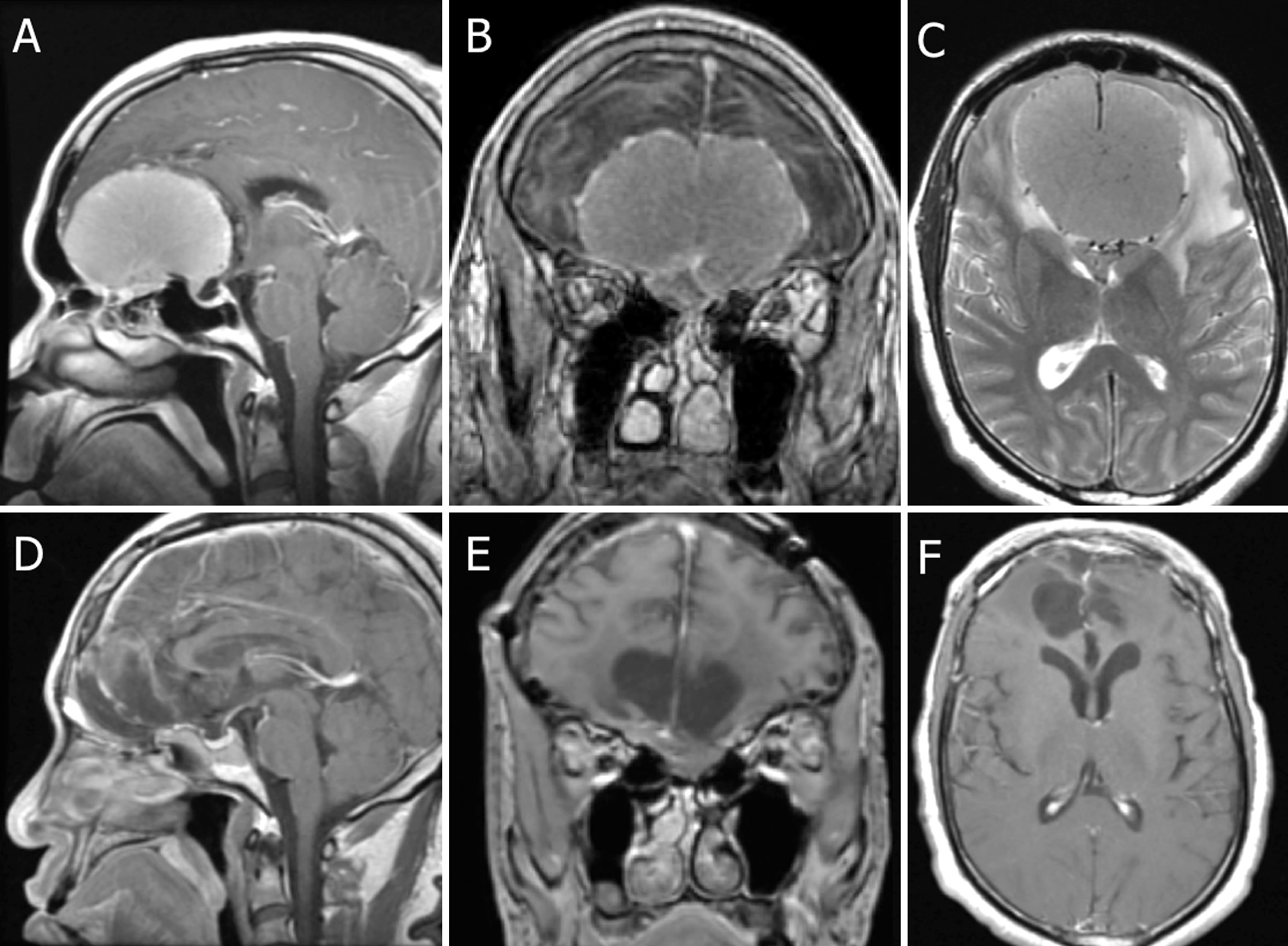 嗅沟脑膜瘤案例