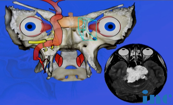 颅底脊索瘤图片