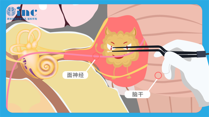 听神经鞘瘤好治不好治？听神经瘤的最佳治疗方法是什么