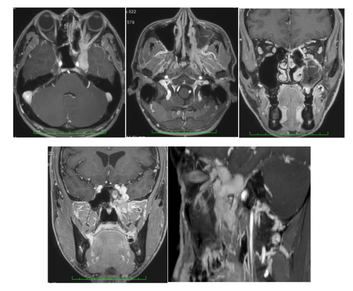 腺样囊性癌案例