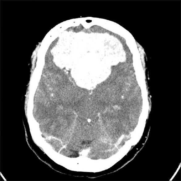 额叶脑膜瘤有哪些症状？怎么治？