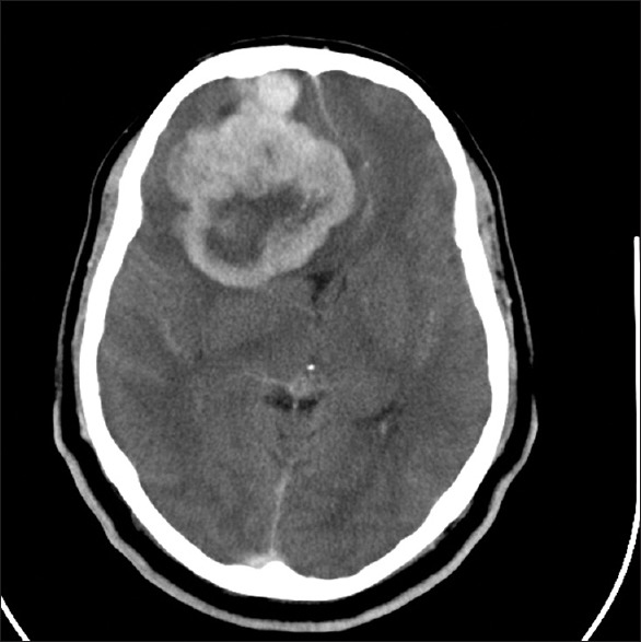 额叶脑膜瘤怎么治