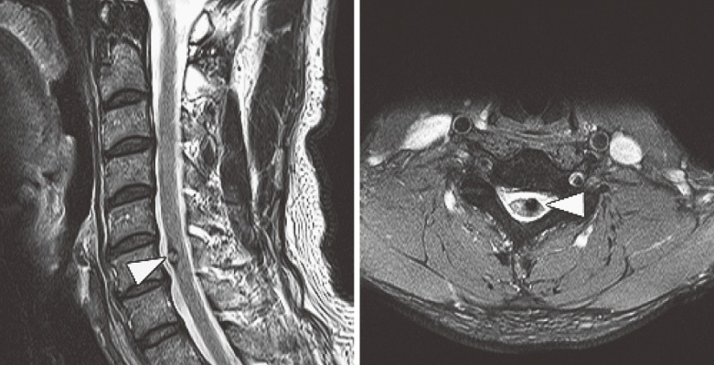 脊髓髓内海绵状血管瘤全切案例一则