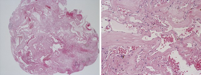 脊髓髓内海绵状血管瘤案例图片