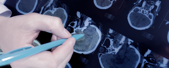 听神经瘤手术图片