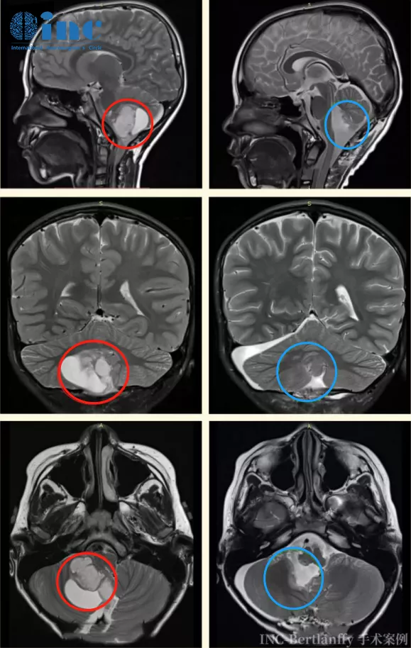 低级别胶质瘤严重吗 案例