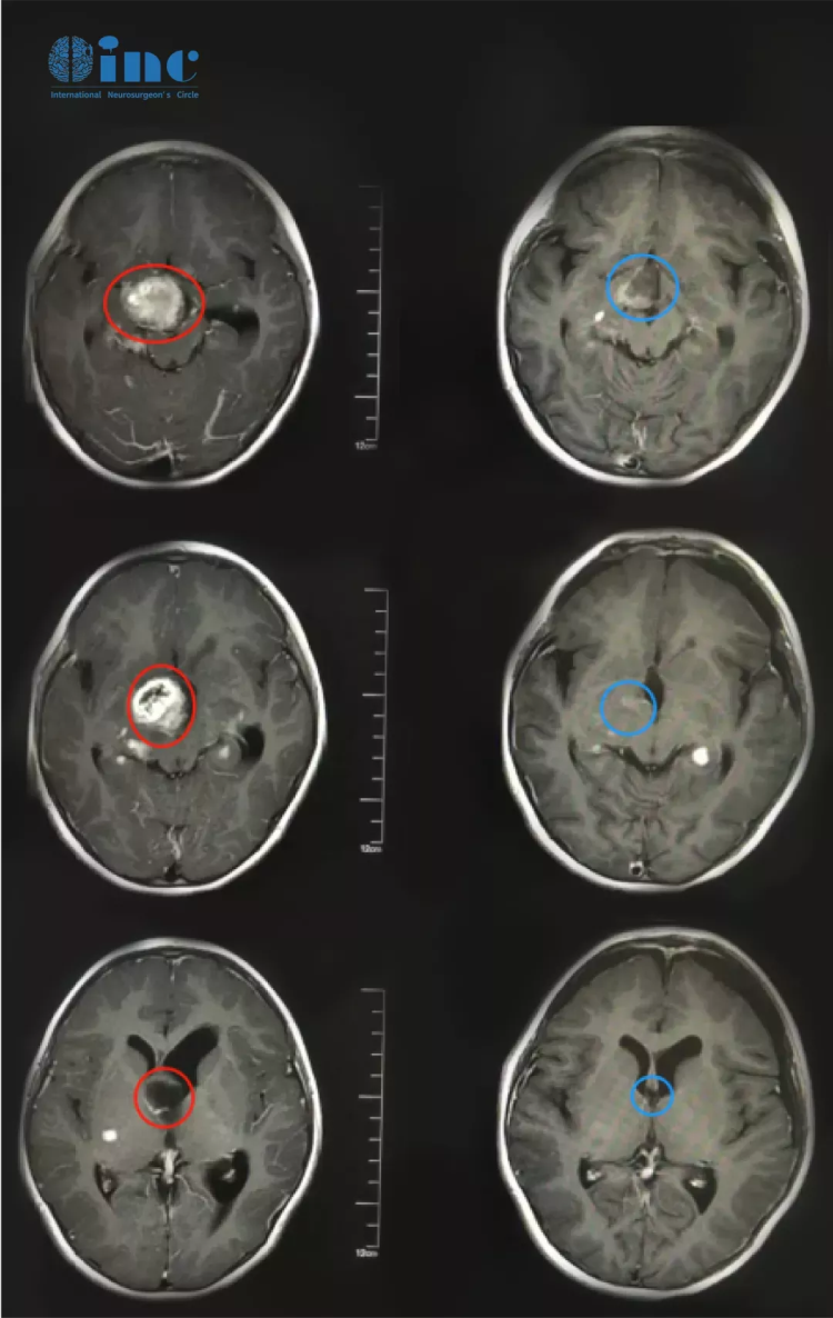 下丘脑胶质瘤手术治疗案例