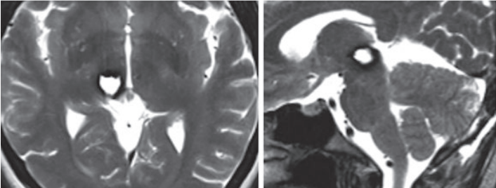 出血性脑海绵状血管瘤图片
