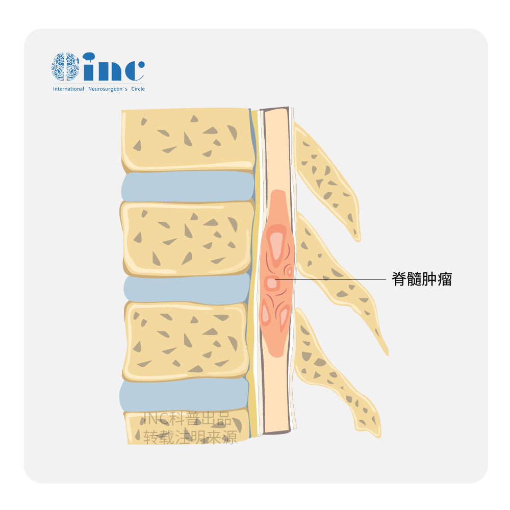 脊髓髓内肿瘤严重吗？早期手术的重要性