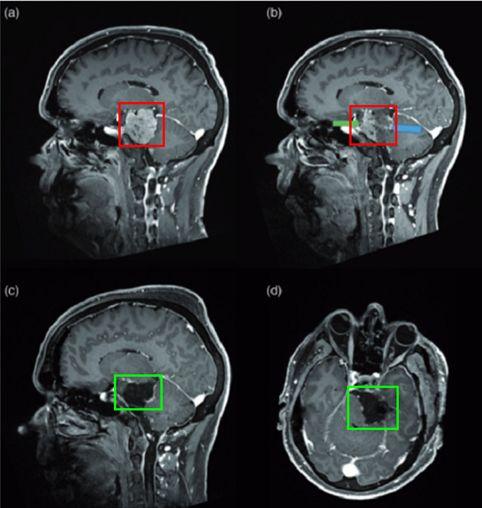 斜坡脑膜瘤手术成功率 图片0