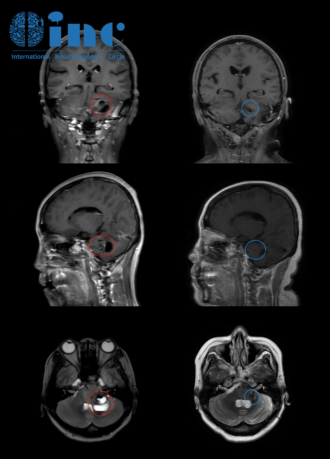 脑干弥漫中线胶质瘤案例图