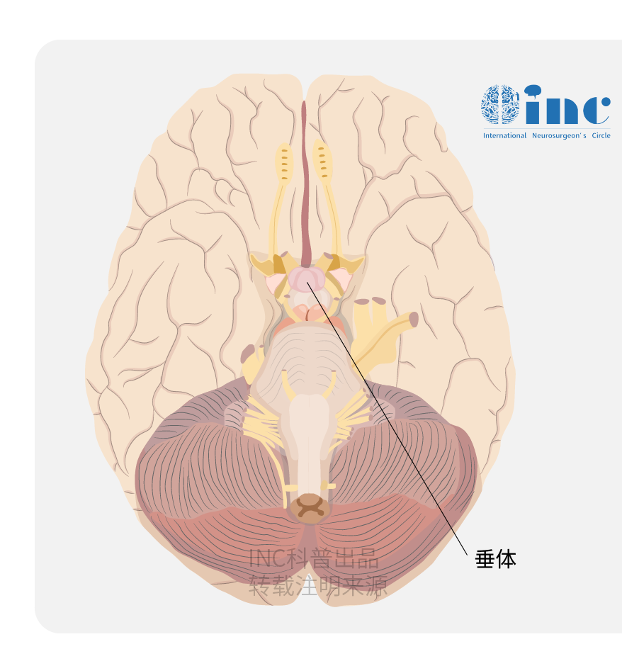 鞍结节脑膜瘤图片2