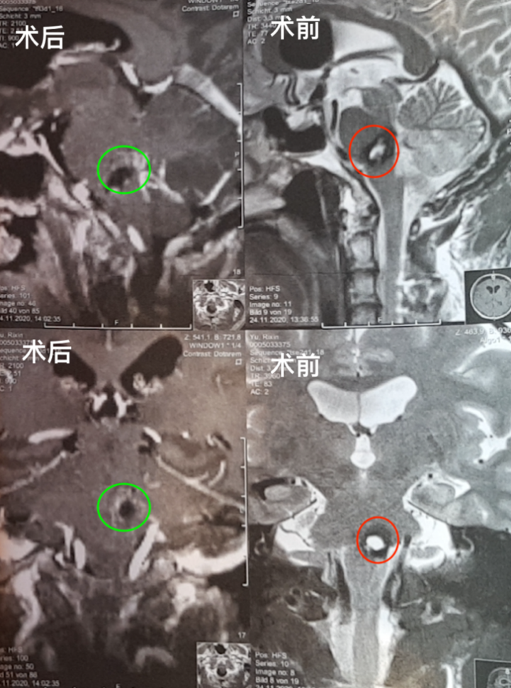 脑干海绵状血管瘤出血后还会二次出血吗？INC之6次出血脑干海绵状血管瘤成功