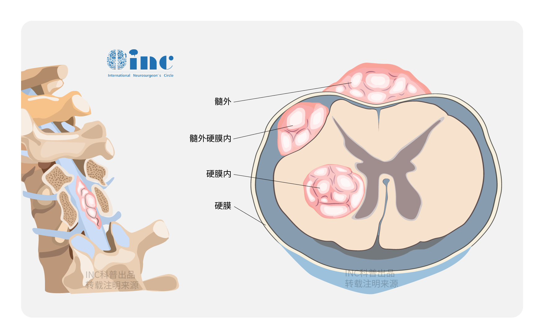 脊髓髓内肿瘤的诊断与治疗,多久可以从手术中恢复？