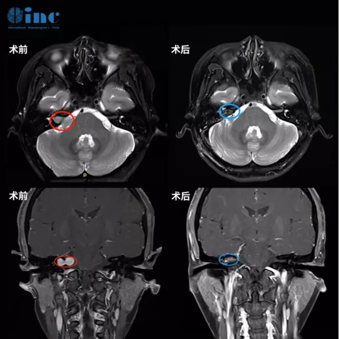 大型听神经瘤治疗必须开颅手术吗？一次性高质量手术全切后不面瘫，预后佳