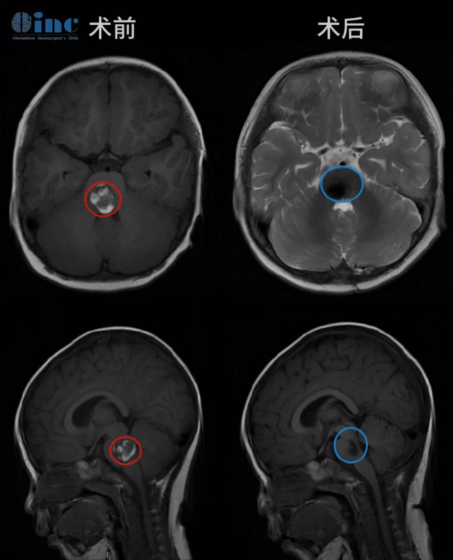 脑干海绵状血管瘤手术风险有多大？2岁女孩如何成功安全手术？