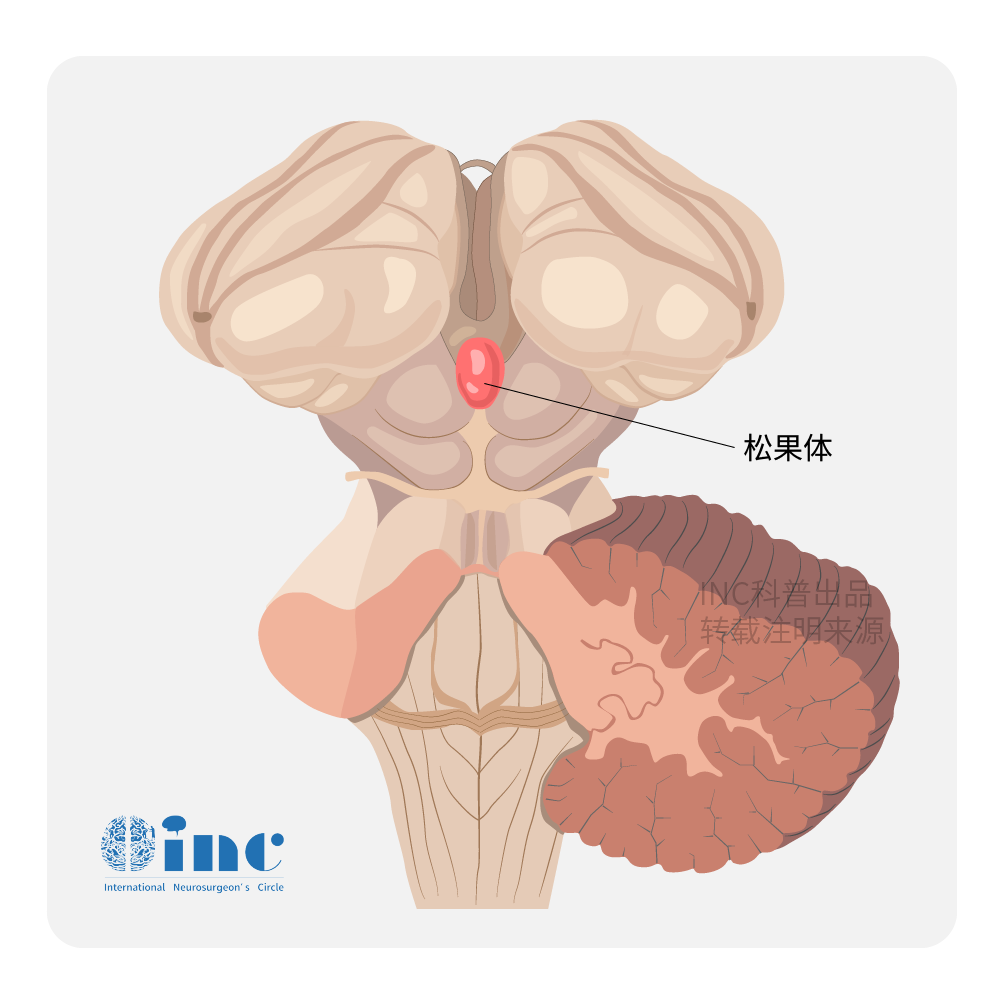 松果体肿瘤手术难度大吗？如何安全手术？