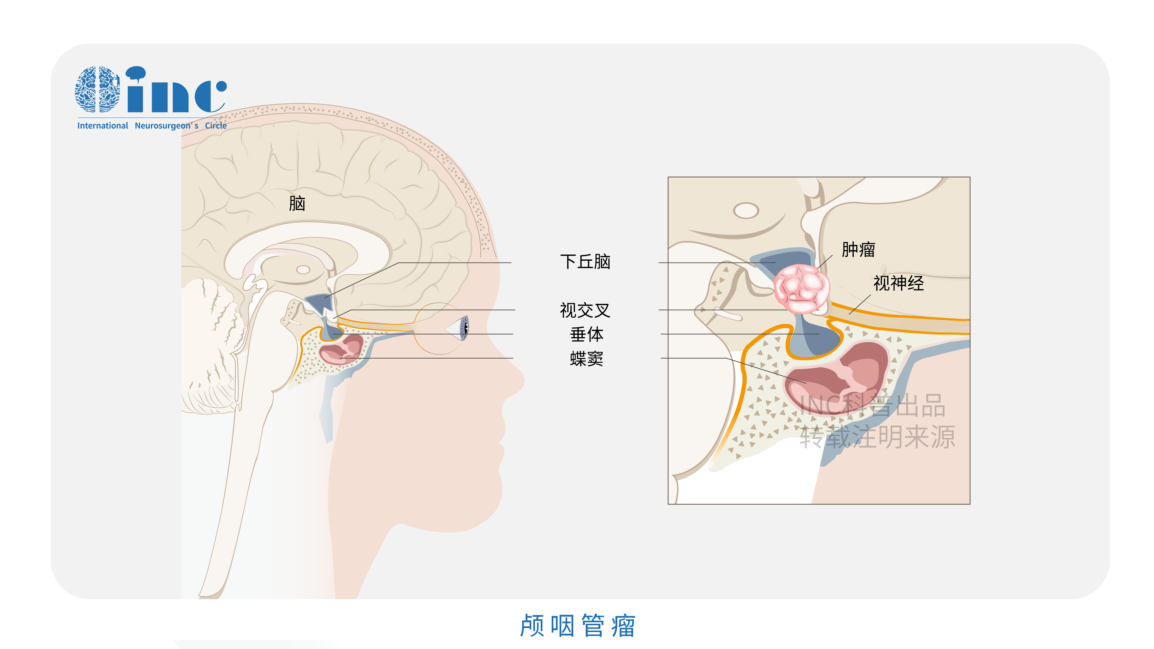 “儿童杀手”颅咽管瘤该如何治疗？