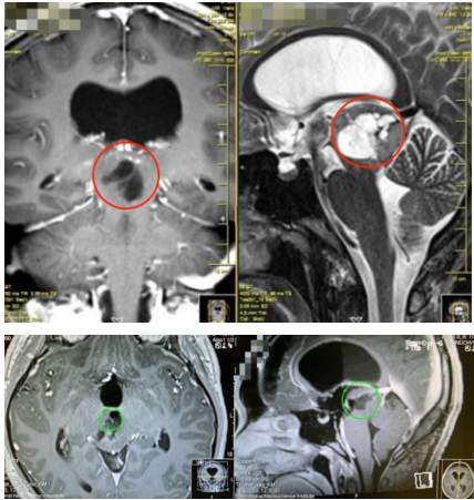 中脑顶盖胶质瘤术后2年近况：同样是中脑顶盖，为何手术效果差别如此大？