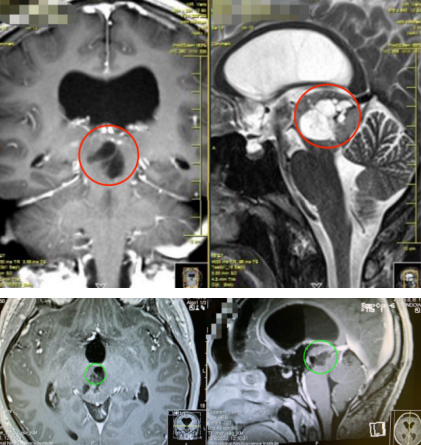 中脑顶盖低级别胶质瘤图片