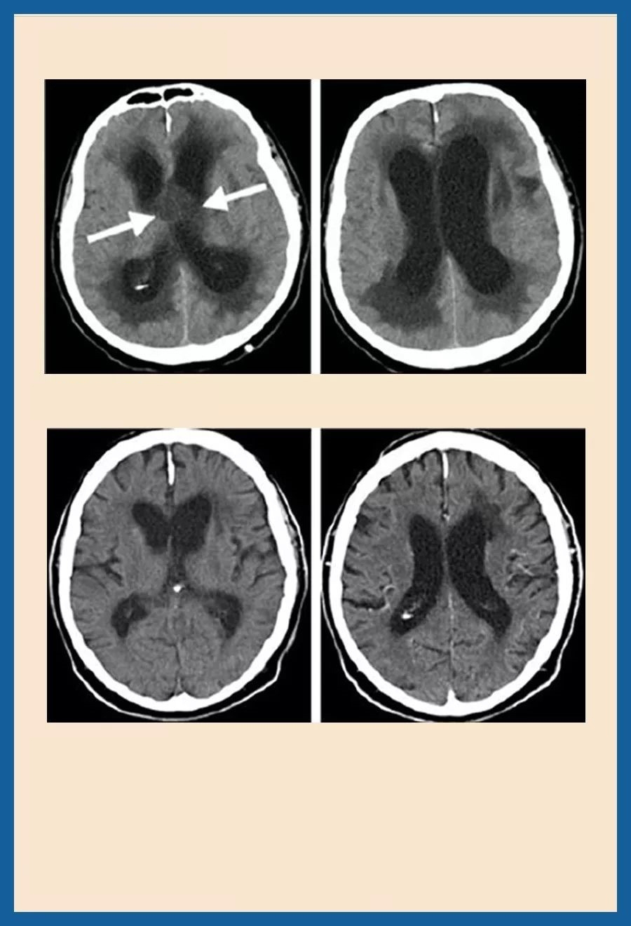 颅咽管瘤有什么危害？得了颅咽管瘤预后怎么样？