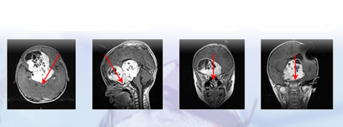 视神经胶质瘤能治好吗？视神经胶质瘤如何全切肿瘤并且保住视力？