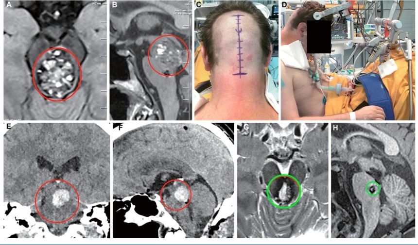 中脑海绵状血管瘤能治愈吗？中脑海绵状血管瘤成功全切案例交流