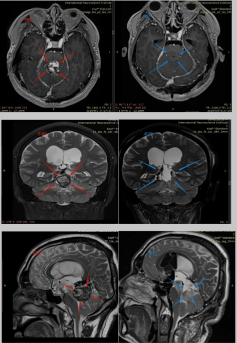 第四脑室肿瘤怎么治疗？第四脑室肿瘤安全全切患者案例分享