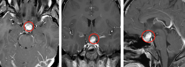 视物模糊检查是视神经胶质瘤，视神经胶质瘤怎么治疗更好？